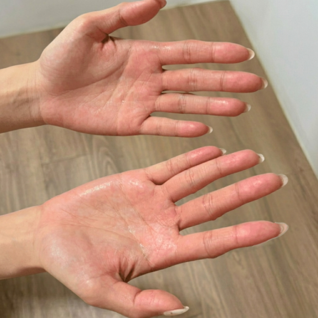 手汗者使用Breeze止汗劑前＿多手汗
